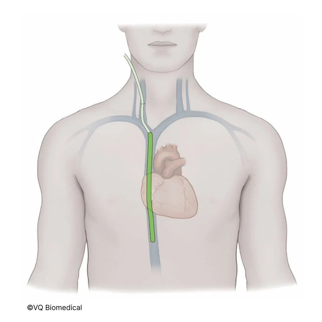 VQ’s official illustration of its intravascular oxygenation catheter